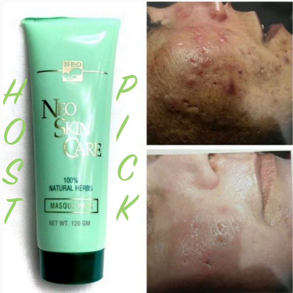 NEW BEST NATURAL HERBS MASK FOR ACNE & PROBLEM